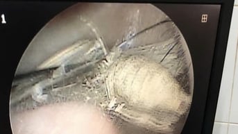 Ù tai, nghe kém do con bọ dài 3cm sống trong tai