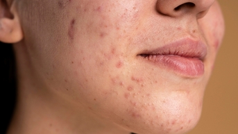 Ngoài 30 tuổi vẫn bị mụn trứng cá phải làm sao?