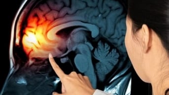 Tưởng trầm cảm sau sinh, đi khám phát hiện u não