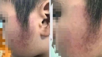 Cô giáo trường tiểu học "lỡ tay" đánh bầm má học sinh