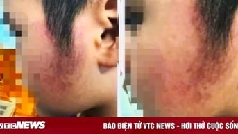 Kỷ luật cô giáo đánh bầm má học sinh ở Đắk Lắk