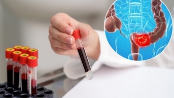 Chuyên gia khuyến cáo dấu hiệu ung thư trực tràng