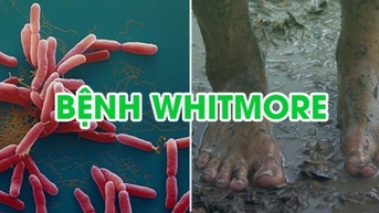 Liên tiếp bệnh nhân mắc vi khuẩn Whitmore nhập viện