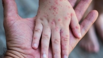 Dịch sởi có thể tăng thời gian tới