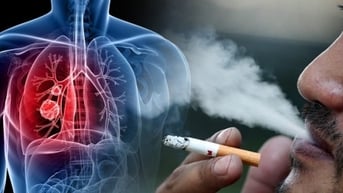 Gánh nặng bệnh ung thư tại Việt Nam; ca bệnh sốt xuất huyết ở TP.HCM vẫn tăng