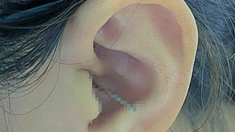 아내가 귀를 청소하던 중 남편이 갑자기 그녀를 껴안았는데, 이로 인해 이물질이 아내의 왼쪽 귀 깊숙이 들어갔습니다.
