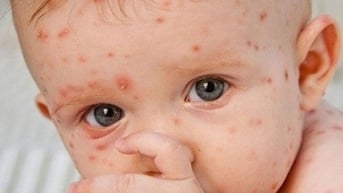 Làm rõ nguyên nhân vì sao số ca mắc sởi tăng