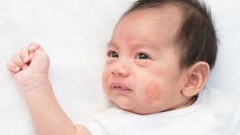 Cảnh giác với bệnh viêm màng não do virus ở trẻ