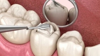 Trám răng xong, chờ bao lâu mới được ăn uống bình thường?