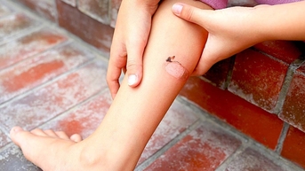 Bị bỏng bô xe có cần tiêm ngừa uốn ván?