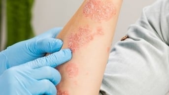 Các bệnh về da tăng do thời tiết