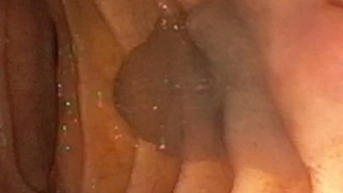 Sán lá gan 20 mm sống trong ống mật chủ cô gái 29 tuổi