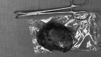 ការវះកាត់ក្រពេញទីរ៉ូអ៊ីតដ៏ធំសម្រាប់ស្ត្រីអាយុ 81 ឆ្នាំ។