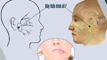 Phòng ngừa liệt dây thần kinh số 7 cách nào?