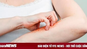 Cách khắc phục da khô, ngứa trong mùa đông