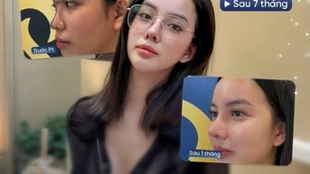 Nâng mũi cấu trúc sụn sườn - Giải pháp tuyệt vời cho dáng mũi tự nhiên và bền vững