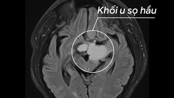 Cứu người đàn ông bị u sọ hầu hiếm gặp