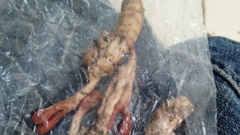 Thêm một trường hợp ngộ độc do ăn nấm ký sinh trên xác ve sầu