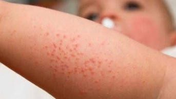 Bệnh sởi có dấu hiệu gia tăng dịp Tết, chăm sóc trẻ bệnh sởi tại nhà như thế nào?