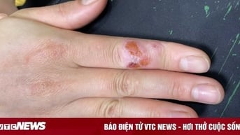 Mắc u hạt từ thú chơi cá cảnh