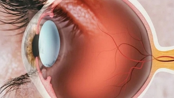 Người bệnh cần chuẩn bị gì trước khi phẫu thuật đục thủy tinh thể?