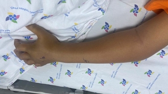 Nhiều trường hợp trẻ bị rắn cắn, hóc xương cá, dị vật ngày tết