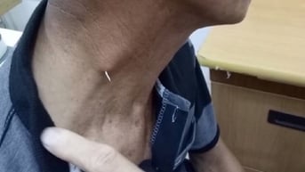 Hóc xương cá, người đàn ông 69 tuổi ở Hải Dương phải nhập viện vì cố làm điều này