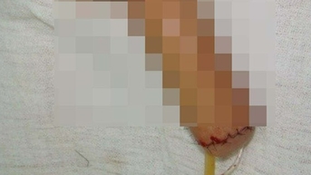 Bệnh viện 108 'lắp mới' dương vật cho nam thanh viên bị ung thư 'cậu nhỏ'