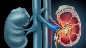 Thói quen gây hại thận cần tránh