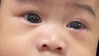Bệnh đau mắt đỏ bùng phát, cách phòng tránh hữu hiệu
