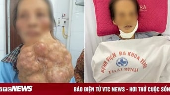 Người phụ nữ mang khối u 5kg trên mặt