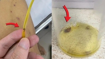 Bùng nổ ca bệnh nhiễm giun lây từ thú cưng