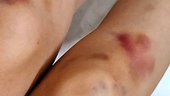 Những dấu hiệu nào của vết bầm cần phải đi khám?
