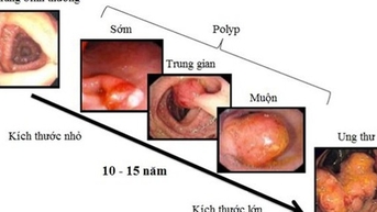 Người đàn ông ở Phú Thọ phát hiện mắc ung thư trực tràng từ một dấu hiệu nhiều người Việt bỏ qua