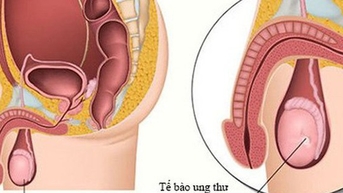 11세 소년이 고환암에 걸렸다, 전문가들이 질병의 징후에 대해 경고