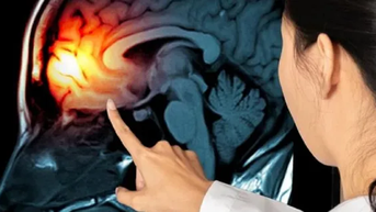 Dấu hiệu thầm lặng của khối u não không nên bỏ qua