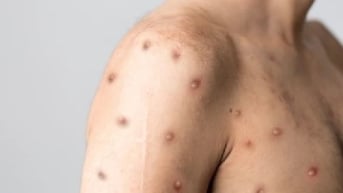 Triệu chứng đầu tiên khi mắc bệnh đậu mùa khỉ là gì?