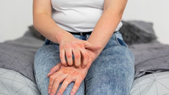 Bệnh vảy nến mụn mủ
