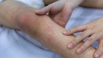 Vì sao không nên truyền dịch tại nhà khi bị sốt xuất huyết?