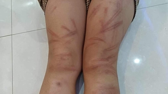 Yêu cầu làm rõ trách nhiệm vụ 6 học sinh mầm non bị đánh bầm tím