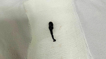 Bị vắt chui vào mũi sau uống ngụm nước suối