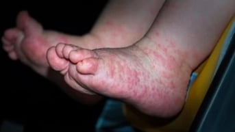 5 chìa khóa giúp phòng bệnh tay chân miệng cho trẻ