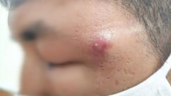 Bị sưng phù mắt, hình thành ổ áp xe do một nốt mụn