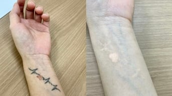 Chật vật xóa hình xăm sau mối tình tan vỡ