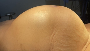 '배가 불러온' 한약 복용 여성 환자, 몸에서 15kg 종양 제거