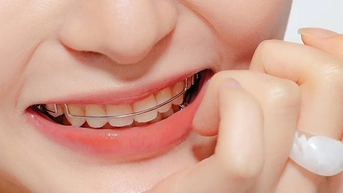 Chăm sóc hàm duy trì sau khi niềng răng hiệu quả nhất từ nha sĩ