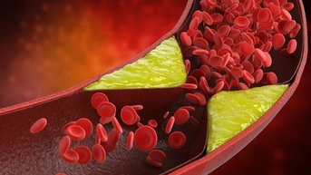 ហេតុអ្វីបានជាកូលេស្តេរ៉ុលកើនឡើង? — នៅ VnExpress Health