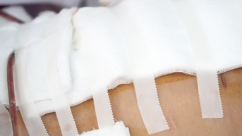 Hút mỡ, người phụ nữ thủng bụng, mất 6 lít máu nên rơi vào hôn mê