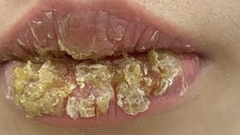 Môi biến dạng, chảy dịch sau khi xăm môi thẩm mỹ, cảnh giác biến chứng xăm môi