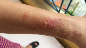 Cảnh báo nhiễm ký sinh trùng từ thú cưng nhưng lầm tưởng là dị ứng